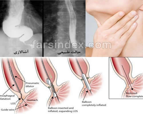 آشالازی | آشالازی چیست