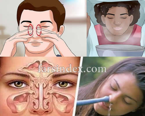 سینوزیت