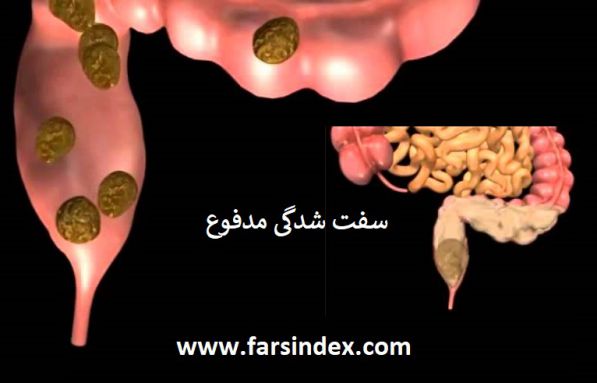 سفت شدن مدفوع / علائم سفت شدن مدفوع / درمان سفت شدن مدفوع / تشخیص سفت شدن مدفوع