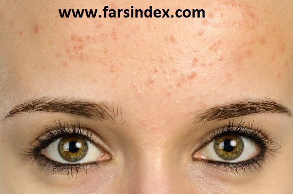 دلیل ایجاد آکنه و جوش
