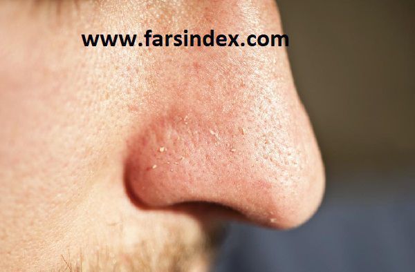 جوش سر سفید | درمان جوش سر سفید جوش سر سفید | درمان جوش سر سفید