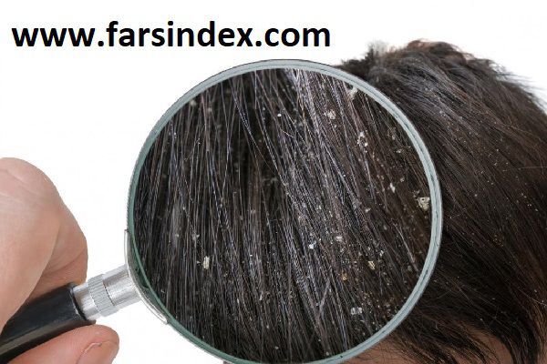 شوره سر شامل پوسته های جمع شده در کف سر است.