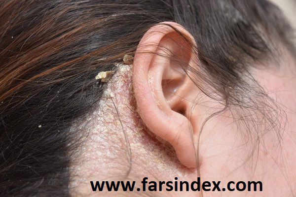 در موارد شدیدتر شوره سر به عنوان بیماری شناخته می شود و باید به پزشک مراجعه شود.