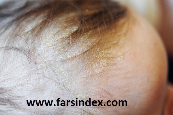 کلاهک گهواره ای یک نوع شوره سر است که نوزادان به آن مبتلا می شوند.