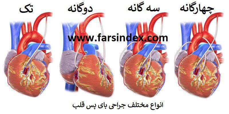 انواع مختلف عمل جراحی بای پس قلب