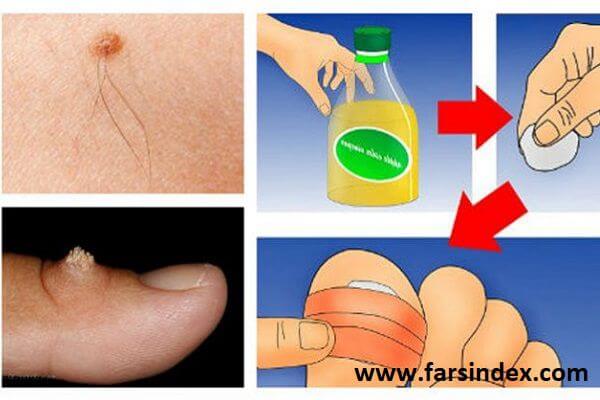چگونه با استفاده از سرکه سیب می توان زگیل را درمان کرد؟