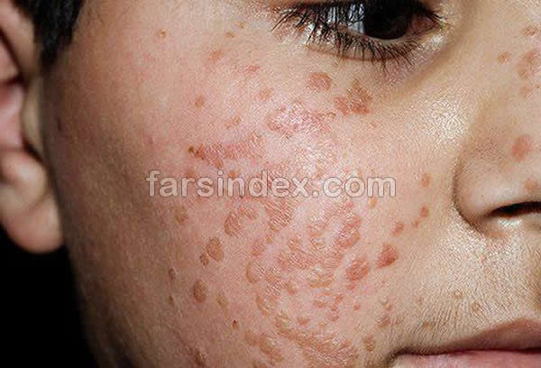 از بین بردن زگیل صورت