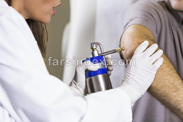 فریز کردن زگیل / درمان زگیل / انجماد زگیل/ برداشتن زگیل
