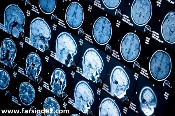 پزشک برای تشخیص خونریزی در مغز با استفاده از سی تی اسکن و MRI از مغز تصویربرداری می کند.